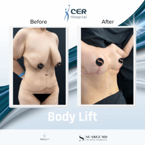 Body Lift – 090226