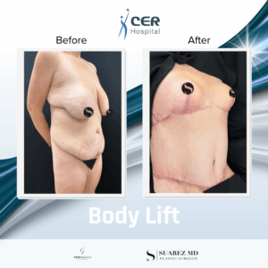 Body Lift – 060226