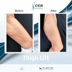 Thigh Lift – 091225