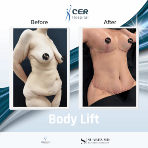 Body Lift – 170226