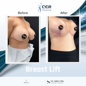 Breast Lift – 180226