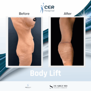 Body Lift – 270126