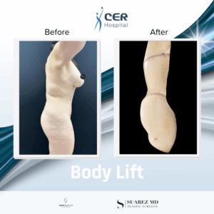 Body Lift – 030226