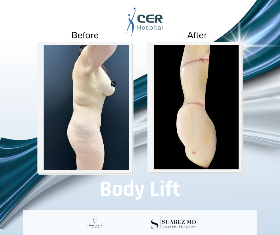 Body Lift - 030226 - Image 2