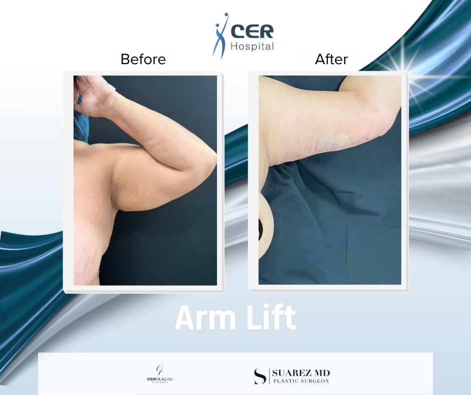 Arm Lift - 040226 - Image 2