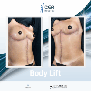 Body Lift – 020426