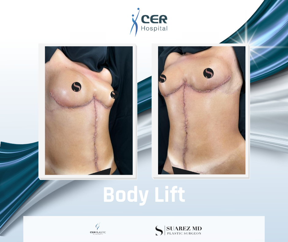 Body Lift - 020426 - Image 2