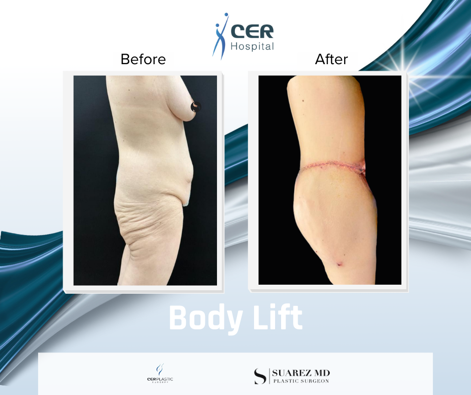 Body Lift - 050226 - Image 2