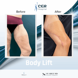 Body Lift – 260126