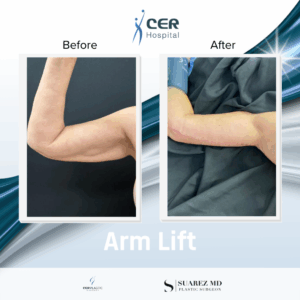 Arm Lift – 290126