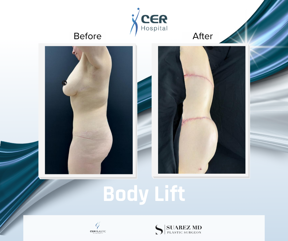 Body Lift - 030226 - Image 3