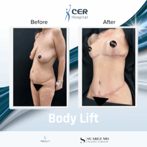 Body Lift – 280126