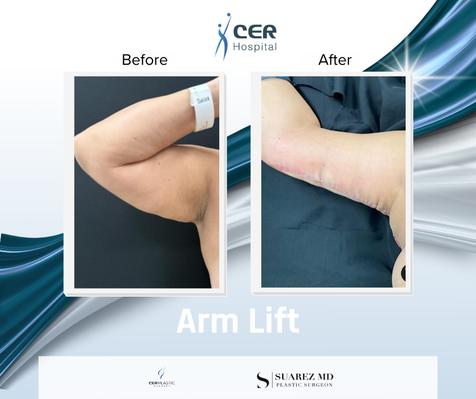 Arm Lift - 040226 - Image 3