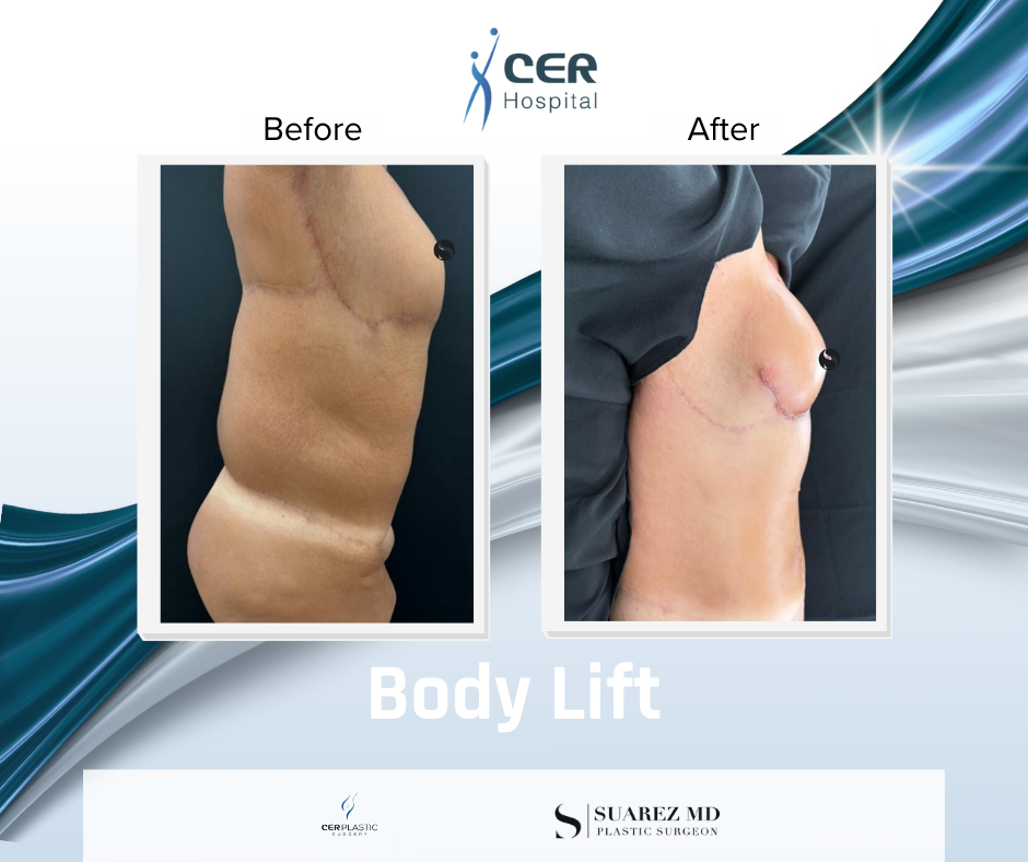 Body Lift - 020426 - Image 3