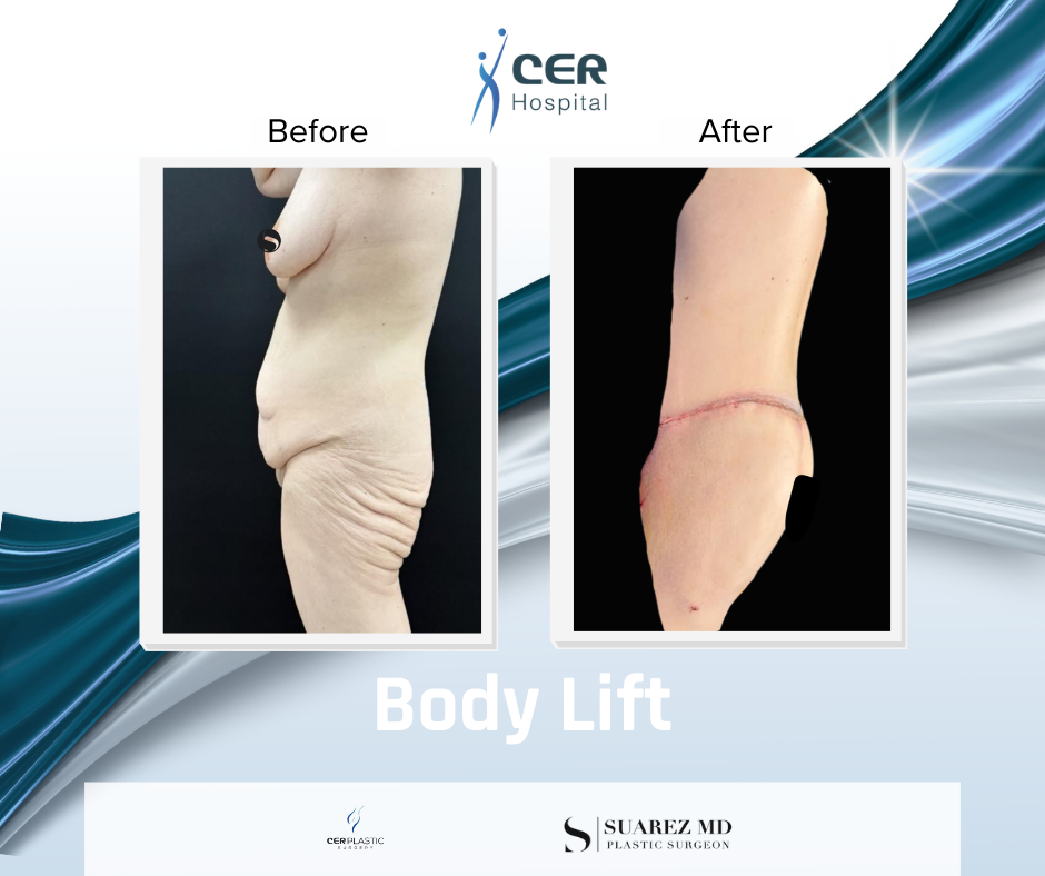 Body Lift - 050226 - Image 3