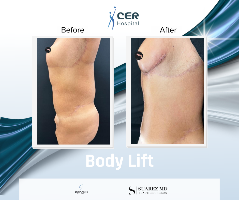 Body Lift - 020426 - Image 4