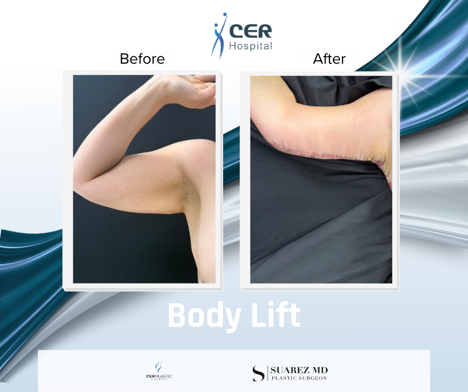 Body Lift - 030226 - Image 6