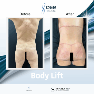 Body Lift – 250226