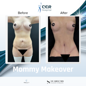 Mommy Makeover – 190326