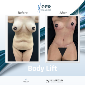 Body Lift – 020326