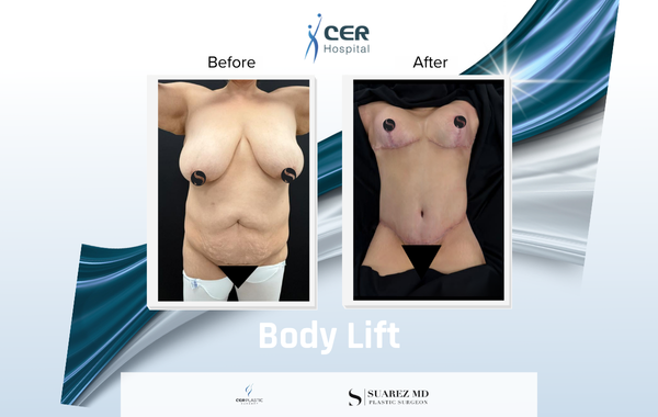 Body Lift - 170326 - Image 3