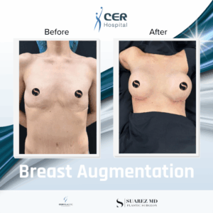 Breast Augmentation – 230226