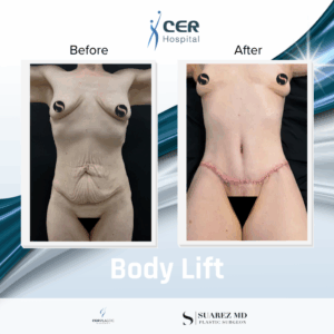 Body Lift – 240226