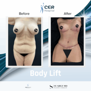 Body Lift – 020326