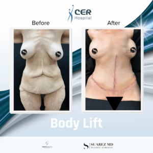 Body Lift – 220126