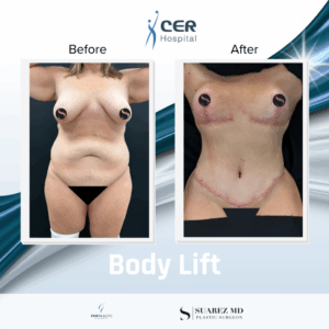 Body Lift – 090326