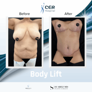 Body Lift – 170326