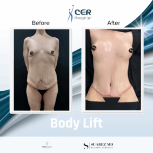 Body Lift – 040326