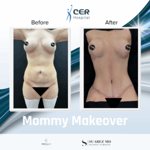 Mommy Makeover – 190326