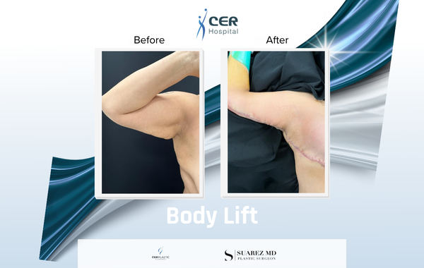 Body Lift - 170326 - Image 11
