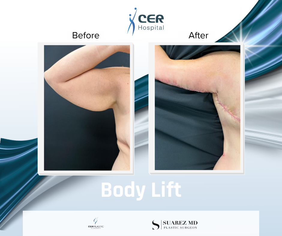 Body Lift - 090326 - Image 10