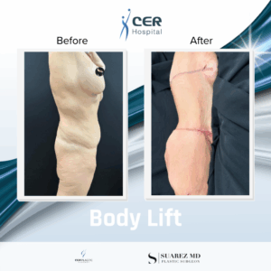 Body Lift – 250226
