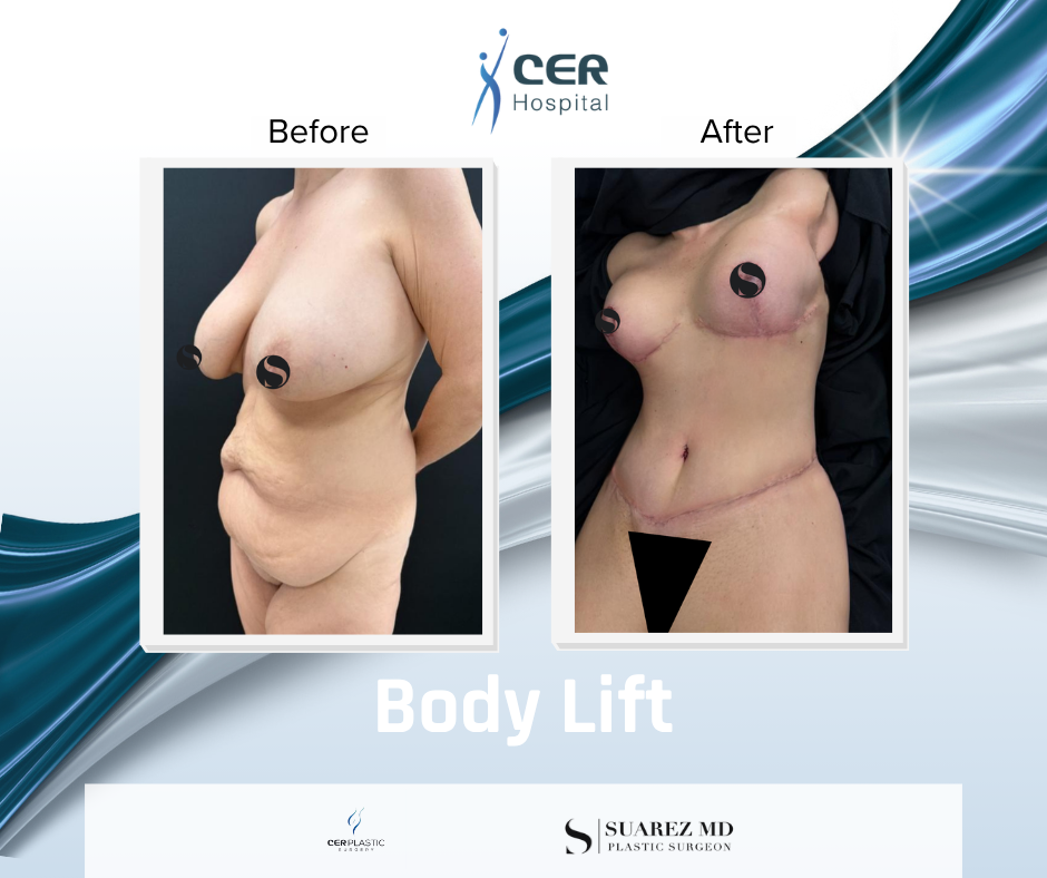 Body Lift - 020326 - Image 2
