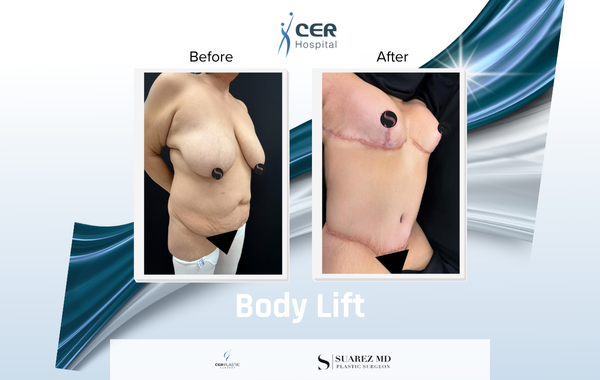 Body Lift - 170326 - Image 4