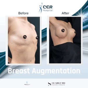 Breast Augmentation – 230226
