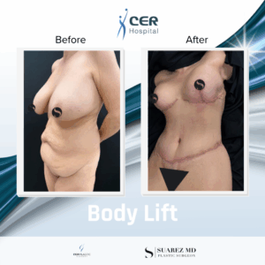 Body Lift – 020326