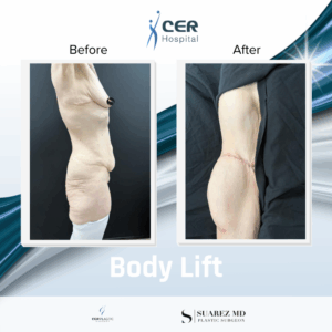 Body Lift – 240226