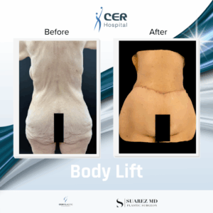 Body Lift – 220126