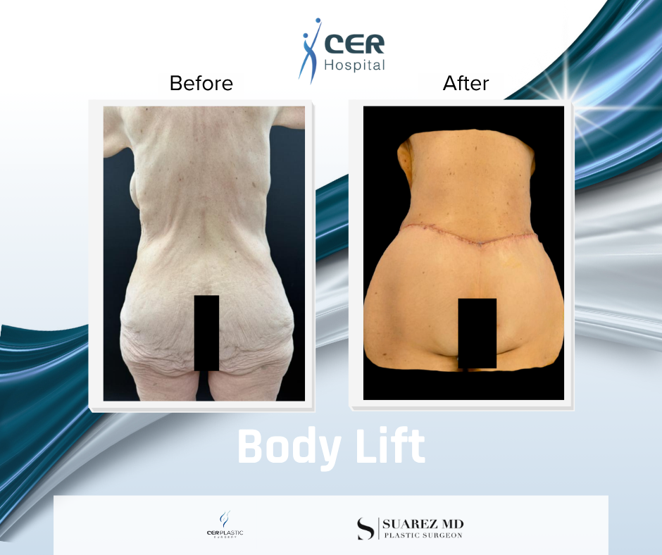 Body Lift - 220126 - Image 2
