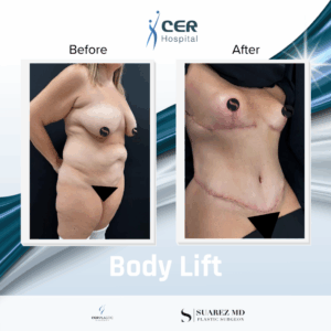 Body Lift – 090326