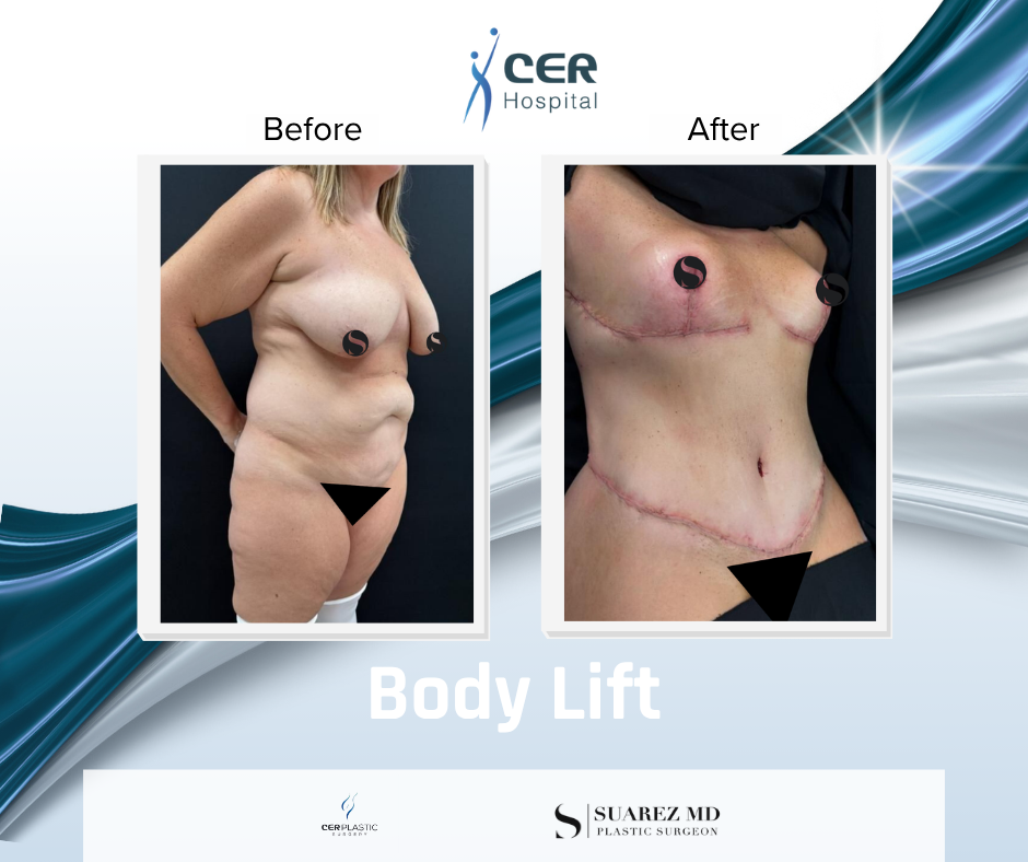 Body Lift - 090326 - Image 2