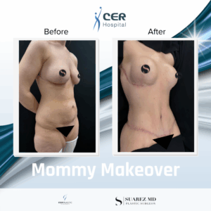 Mommy Makeover – 190326