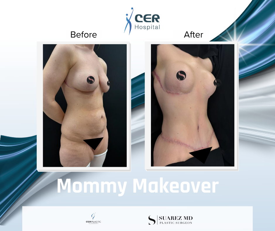 Mommy Makeover - 190326 - Image 2