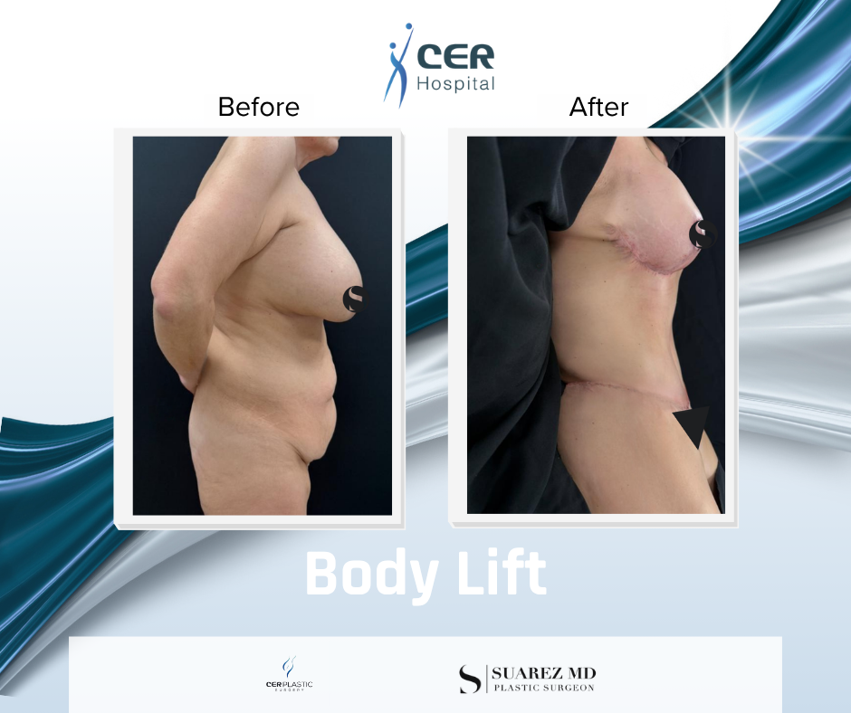 Body Lift - 020326 - Image 3