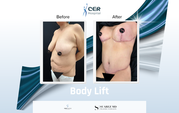 Body Lift - 170326 - Image 5