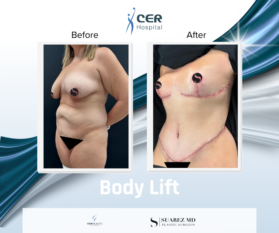 Body Lift - 090326 - Image 3